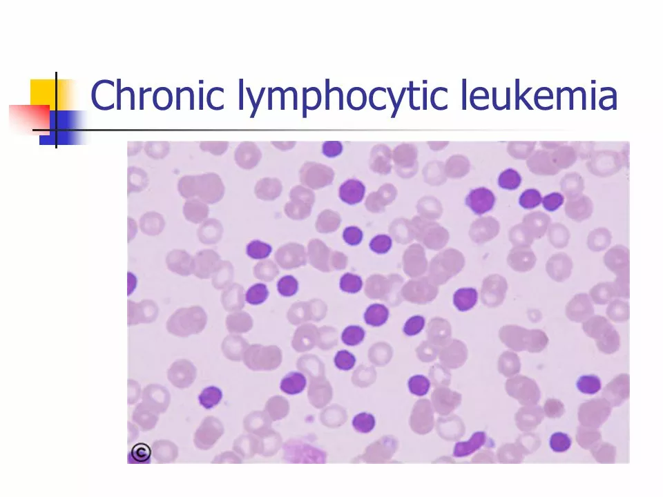 The Importance of Support Systems for Chronic Lymphocytic Leukemia Patients