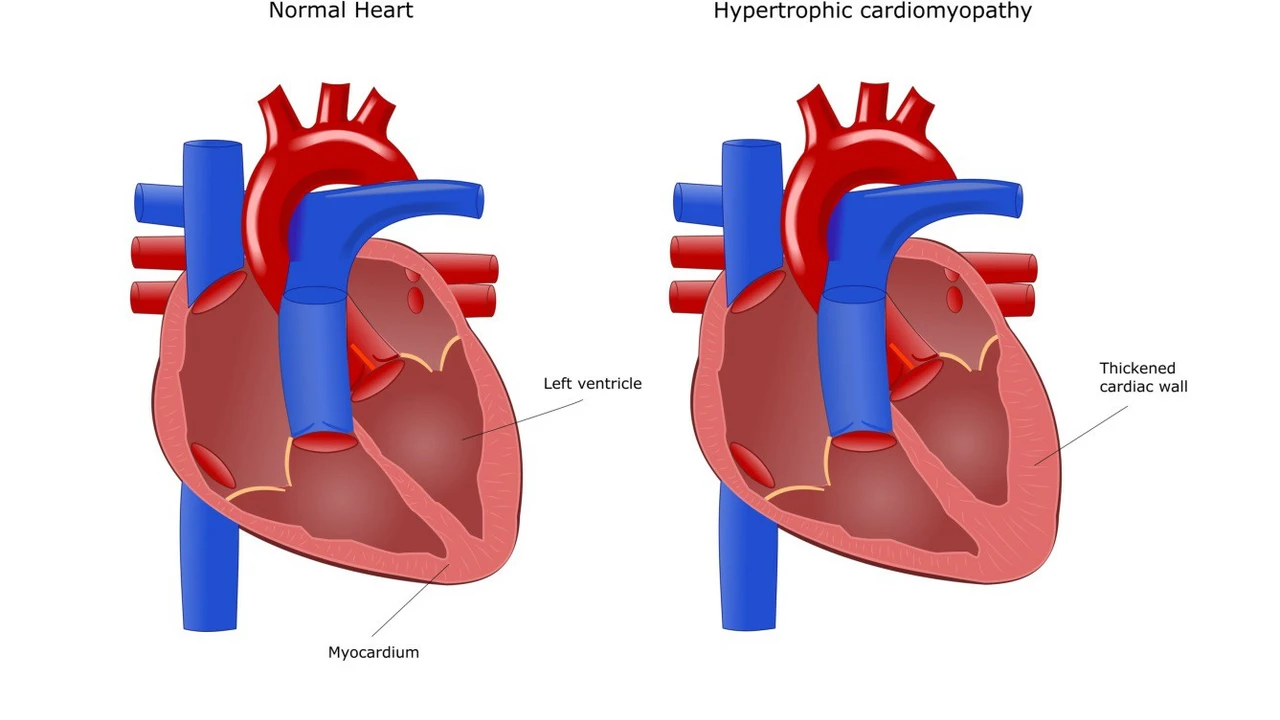 Hypertrophic Subaortic Stenosis in Athletes: How to Stay Safe and Perform at Your Best